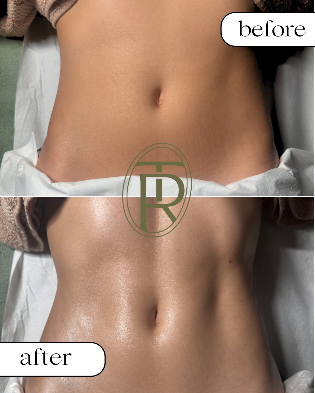 Before and after body treatment at Trēs Studios