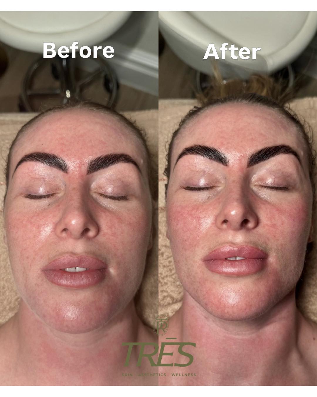Before and after skin treatment at Trēs Studios